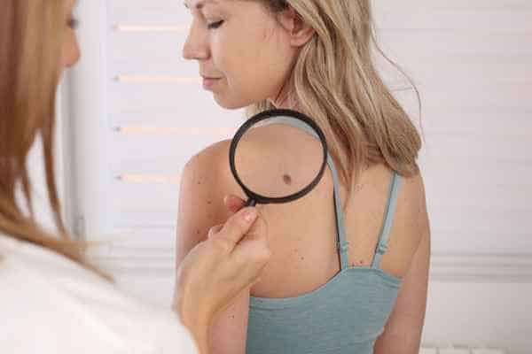 What Are Traditional Skin Lesion Removal Methods Luton?