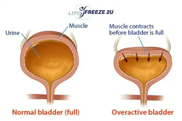 diagram of overactive bladder treatment Luton