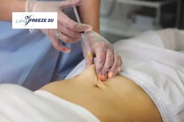 How Does Aqualyx Fat Dissolving Injection Work to Break Down Fat Luton?