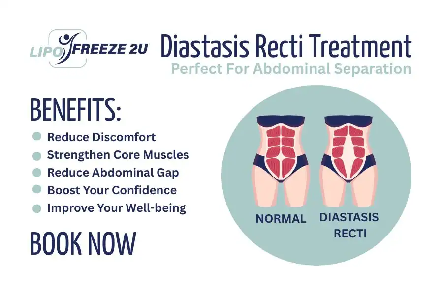 How Long Will It Take to See Improvements in Diastasis Recti Luton