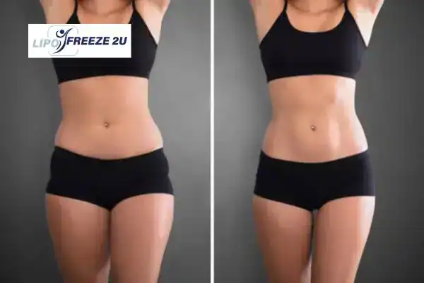 How Can LIPO FREEZE 2U Support Your Post-Pregnancy Body Recovery Luton?