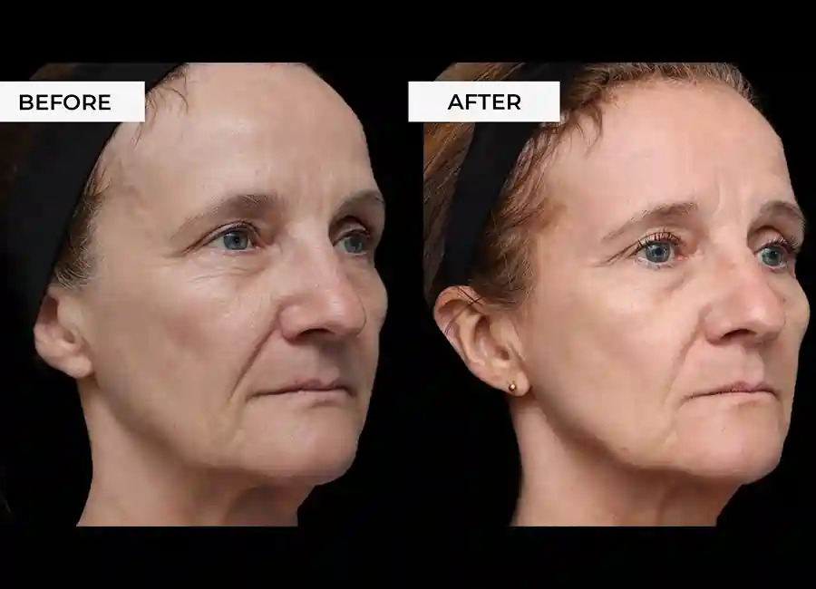 How Many RF Microneedling Sessions Will You Need to See a Difference Luton?