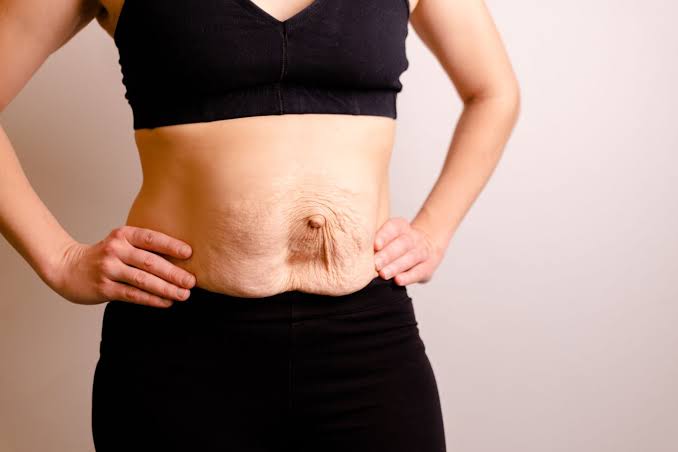 Is Surgery Really the Only Way to Repair Diastasis Recti Luton?