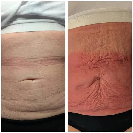 How Does RF Microneedling Improve Crepey, Thin and Uneven Skin Texture Luton?