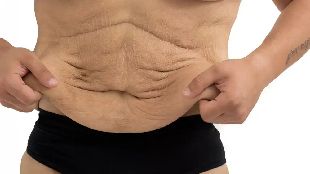 Why Does Weight Loss Medication Leave Some People With Loose or Sagging Skin Luton?